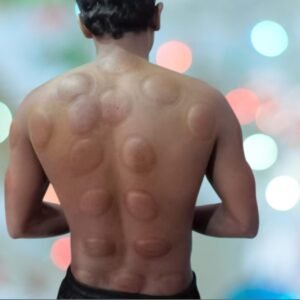 Cupping Therapy For Dorsal | after cupping